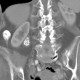 Pyelolithiasis, nephrolithiasis, kidney stones in renal pelvis: CT - Computed tomography
